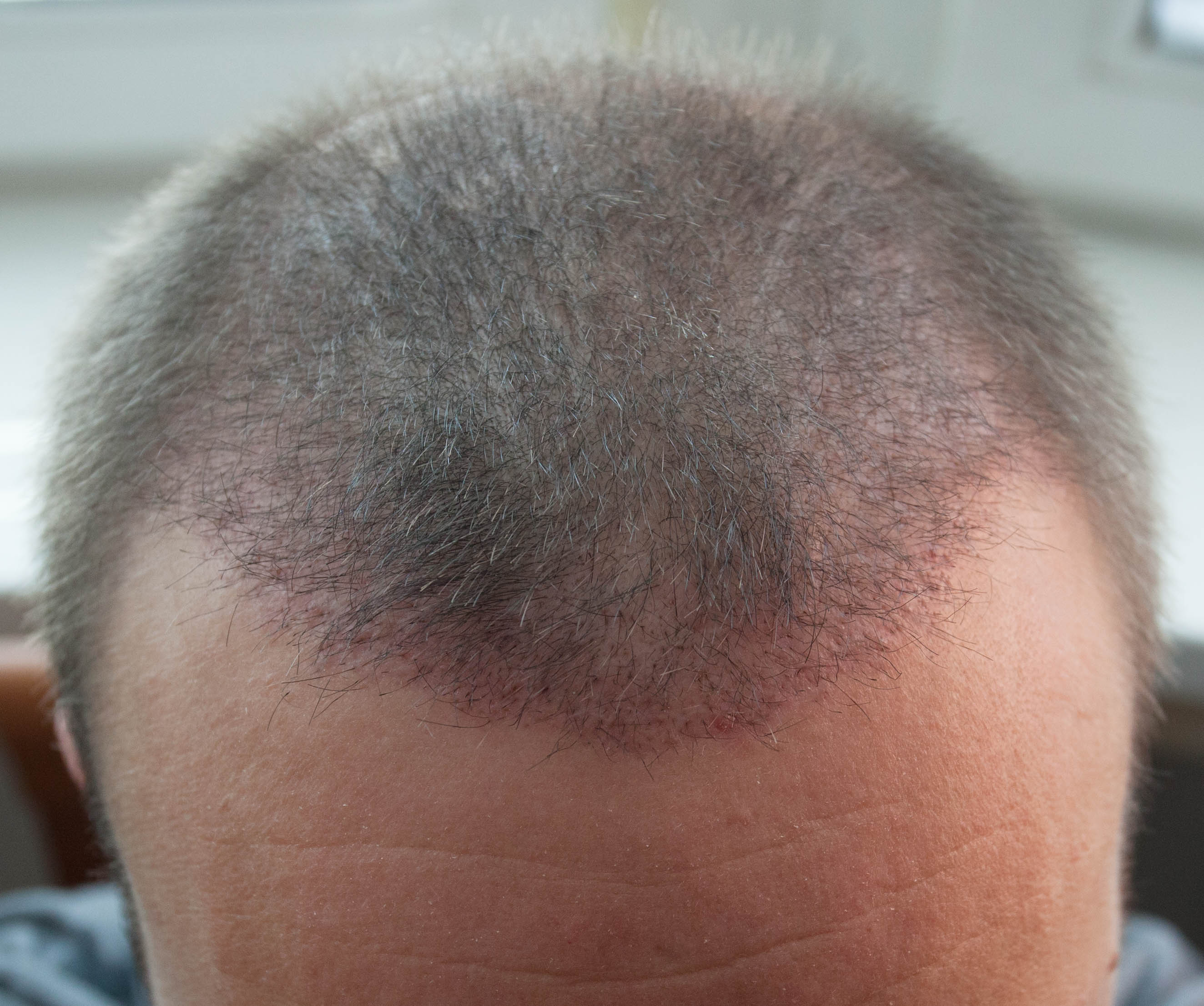 Пересадка волос фото по месяцам