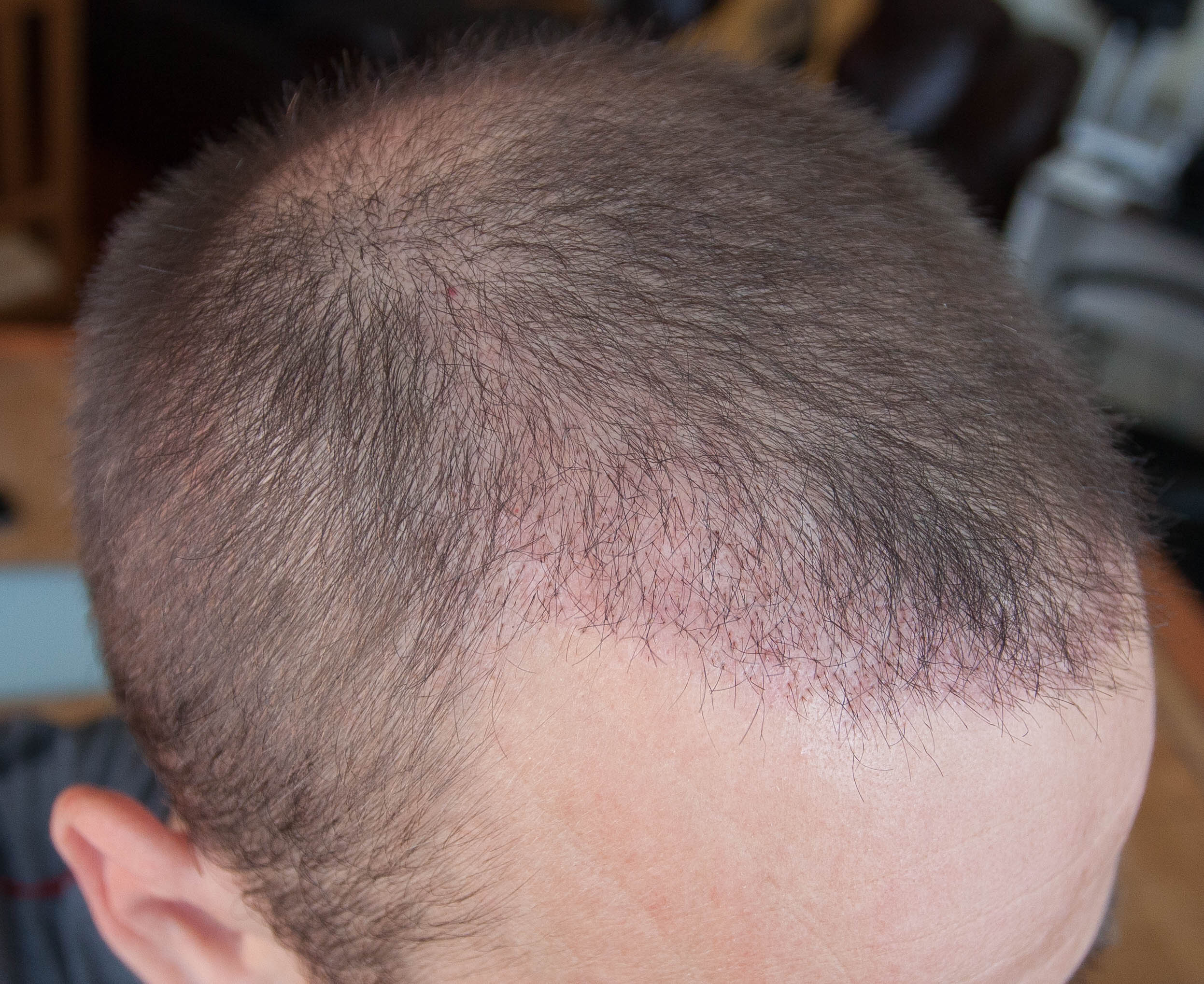 За сколько отрастают волосы на голове у мужчин за неделю
